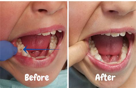 Dentist washes oral cavity, dental treatment - sound effect