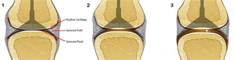 Cracking of bones or cartilage joints - sound effect