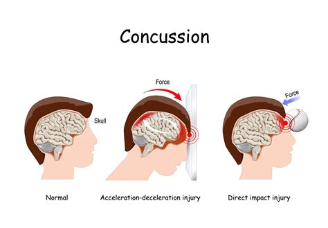 Concussion effect, shock, hearing loss (2) - sound effect