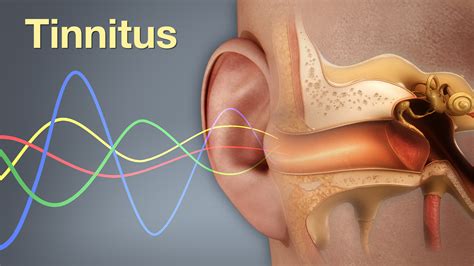 Tinnitus sound effects