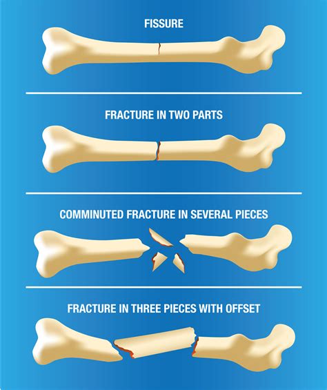 Bone fracture, bone crack - sound effect