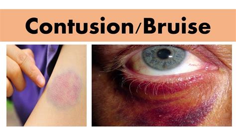 Contusion sound effects