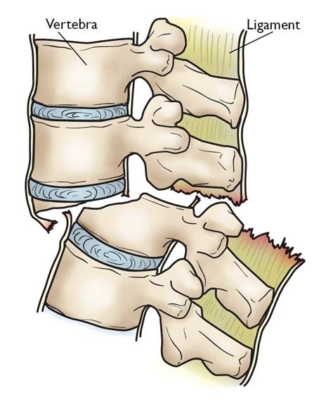 Rotation and fracture of the spine - sound effect