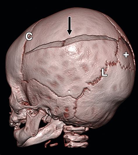 Skull fracture - sound effect