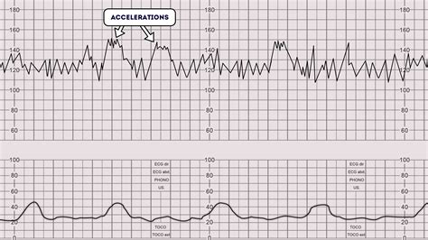 Heartbeat followed by acceleration - sound effect
