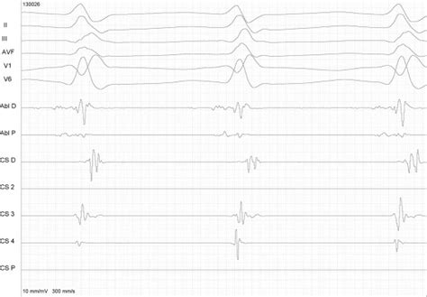 Heartbeat followed by acceleration - sound effect