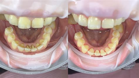 Teeth cleaning (2) - sound effect